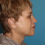 Facelift Before & After Patient #1975