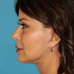 Facelift Before & After Patient #1994