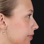 Fillers Before & After Patient #2030