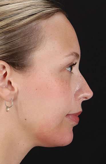 Fillers Before & After Patient #2030