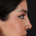 Fillers Before & After Patient #2041
