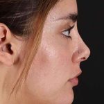Fillers Before & After Patient #2052