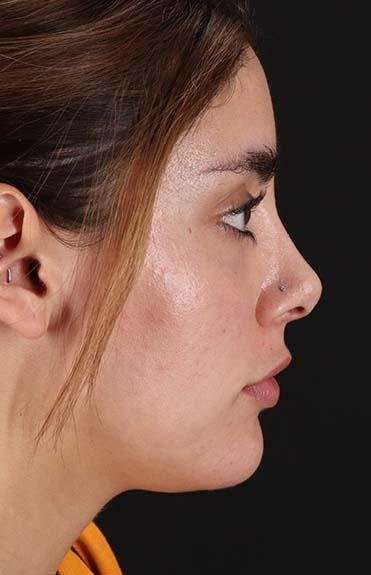 Fillers Before & After Patient #2052