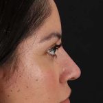 Fillers Before & After Patient #2063
