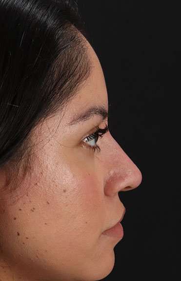 Fillers Before & After Patient #2063