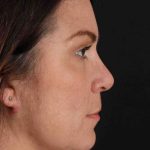 Lip Lift Before & After Patient #2133