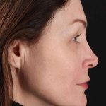Lip Lift Before & After Patient #2144