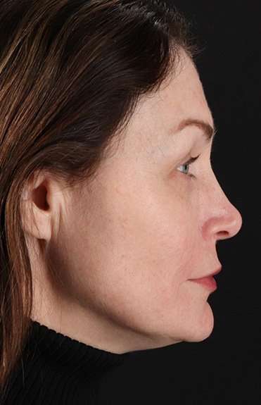 Lip Lift Before & After Patient #2144