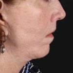 Lip Lift Before & After Patient #2155