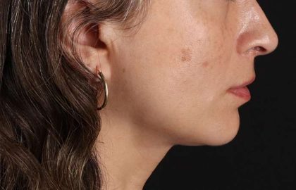 Lip Lift Before & After Patient #2166