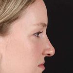 Liquid Rhinoplasty Before & After Patient #2177