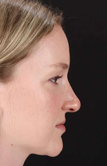 Liquid Rhinoplasty Before & After Patient #2177