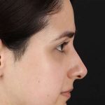 Liquid Rhinoplasty Before & After Patient #2188