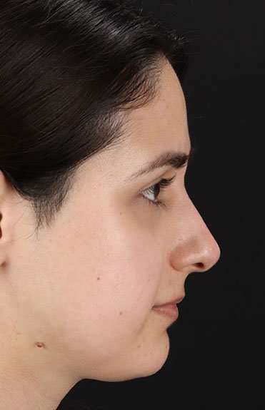 Liquid Rhinoplasty Before & After Patient #2188
