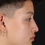 Liquid Rhinoplasty Before & After Patient #2199