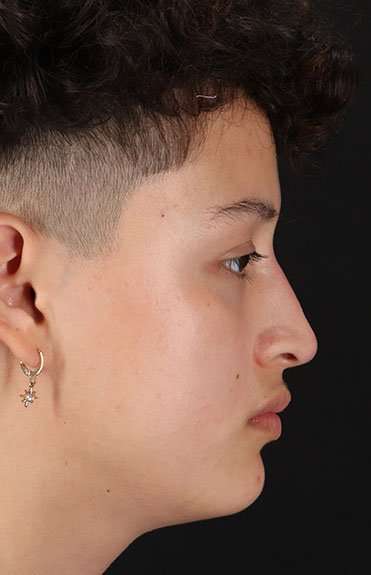 Liquid Rhinoplasty Before & After Patient #2199