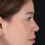 Liquid Rhinoplasty Before & After Patient #2210