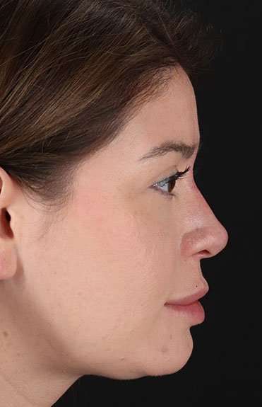 Liquid Rhinoplasty Before & After Patient #2210