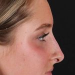Liquid Rhinoplasty Before & After Patient #2221
