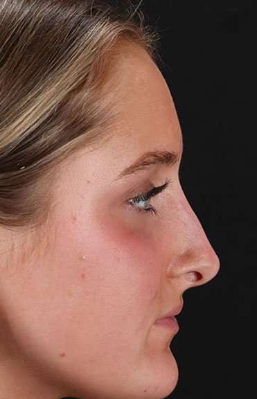 Liquid Rhinoplasty Before & After Patient #2221