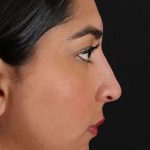 Liquid Rhinoplasty Before & After Patient #2232