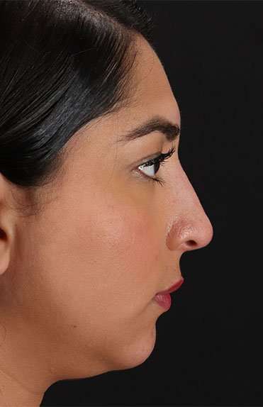 Liquid Rhinoplasty Before & After Patient #2232