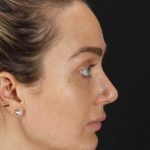 Browlift Before & After Patient #1297
