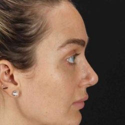 Browlift Before & After Patient #1297