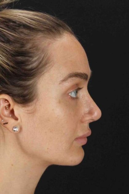 Browlift Before & After Patient #1297