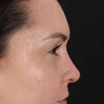 Liquid Rhinoplasty Before & After Patient #2243