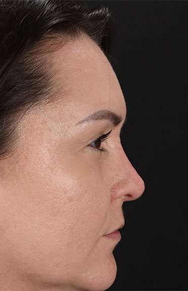Liquid Rhinoplasty Before & After Patient #2243