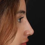 Liquid Rhinoplasty Before & After Patient #2254