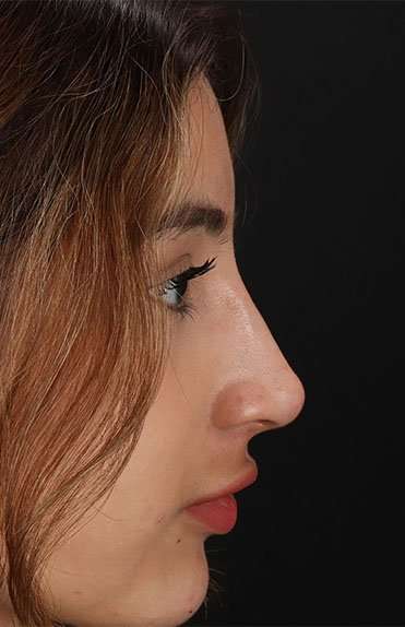 Liquid Rhinoplasty Before & After Patient #2254