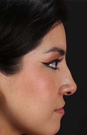 Liquid Rhinoplasty Before & After Patient #2265
