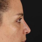 Liquid Rhinoplasty Before & After Patient #2276