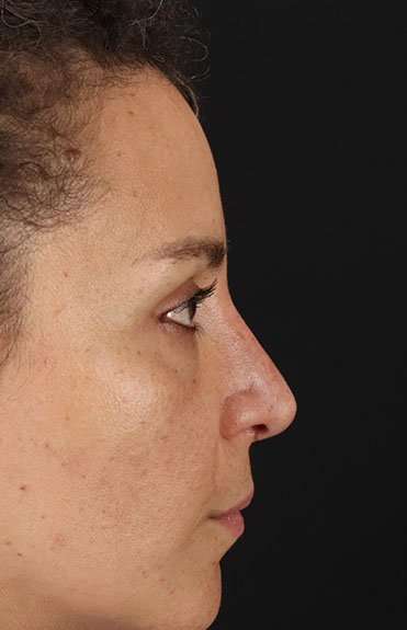 Liquid Rhinoplasty Before & After Patient #2276
