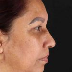 Lower Blepharoplasty Before & After Patient #2321