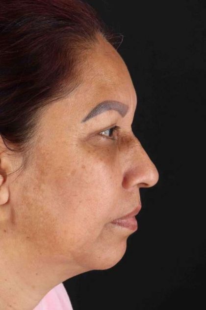 Lower Blepharoplasty Before & After Patient #2321