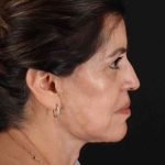 Lower Blepharoplasty Before & After Patient #2343