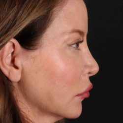 Browlift Before & After Patient #1308