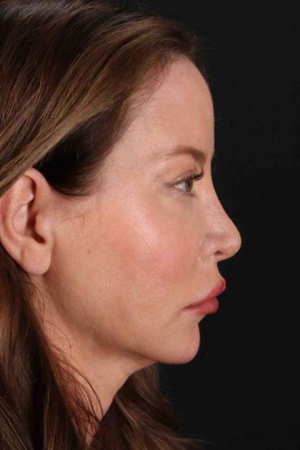 Browlift Before & After Patient #1308