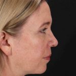 Lower Blepharoplasty Before & After Patient #2376