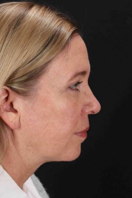 Lower Blepharoplasty Before & After Patient #2376