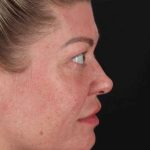 Lower Blepharoplasty Before & After Patient #2387
