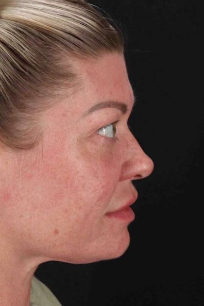 Lower Blepharoplasty Before & After Patient #2387