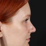 Lower Blepharoplasty Before & After Patient #2409