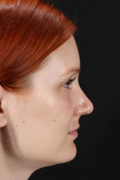 Lower Blepharoplasty Before & After Patient #2409