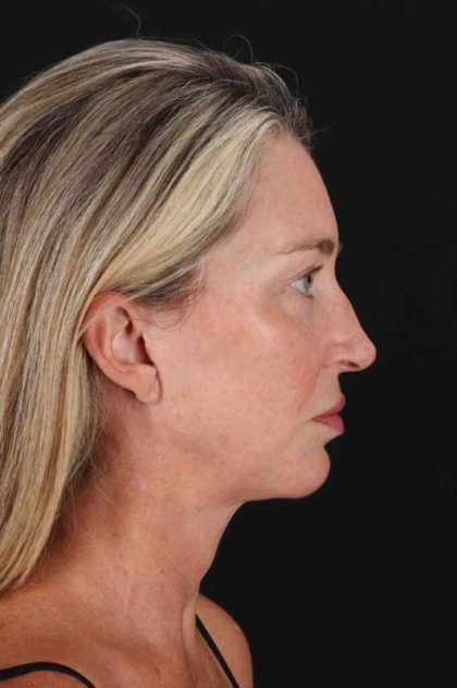 Neck Lift Before & After Patient #2441