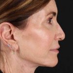 Neck Lift Before & After Patient #2452