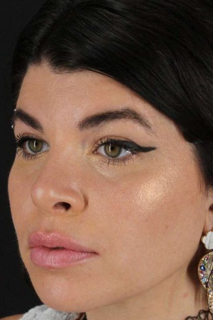 Browlift Before & After Patient #1220